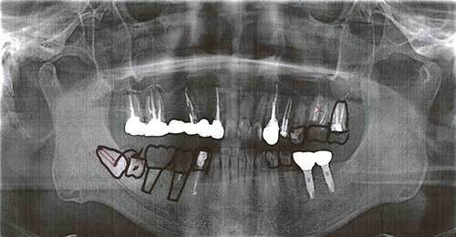 私の歯.jpg
